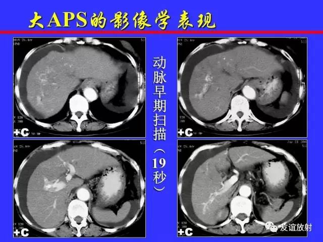 肝实质异常灌注CT、MRI评价