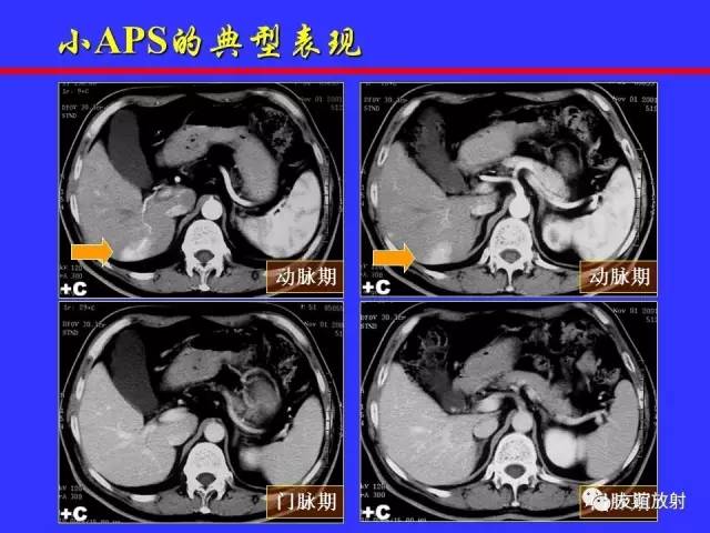 肝实质异常灌注CT、MRI评价