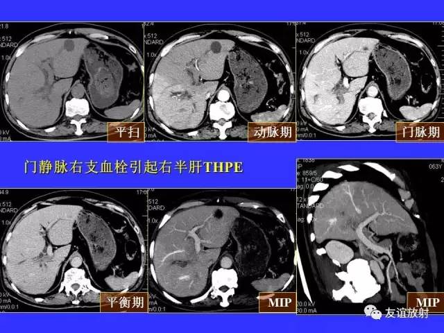 肝实质异常灌注CT、MRI评价