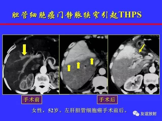 肝实质异常灌注CT、MRI评价