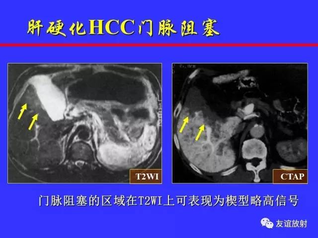 肝实质异常灌注CT、MRI评价