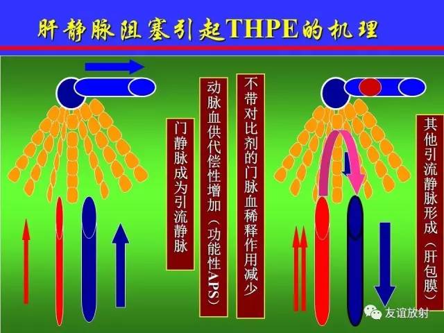 肝实质异常灌注CT、MRI评价
