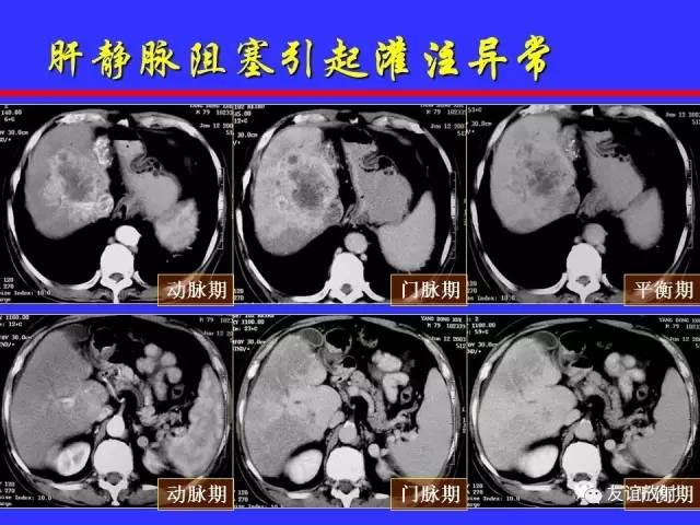 肝实质异常灌注CT、MRI评价