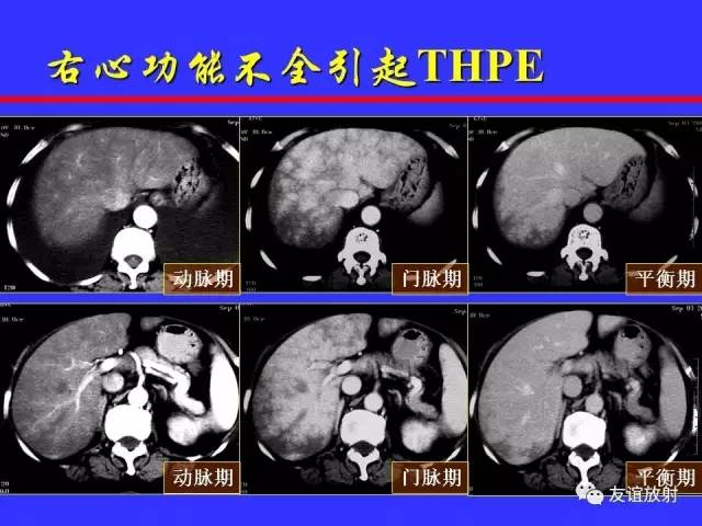 肝实质异常灌注CT、MRI评价