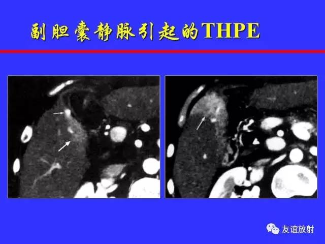 肝实质异常灌注CT、MRI评价