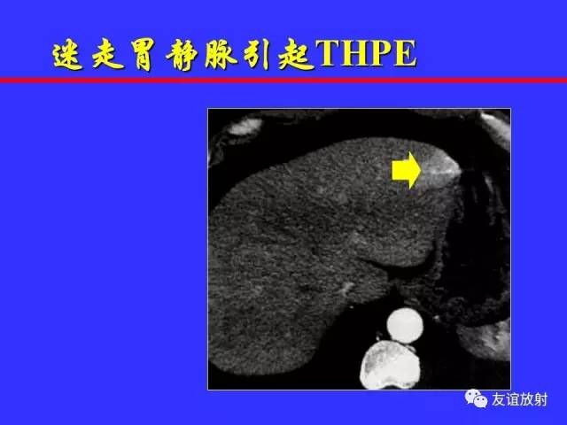 肝实质异常灌注CT、MRI评价