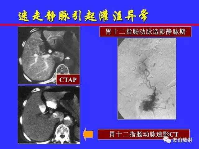 肝实质异常灌注CT、MRI评价
