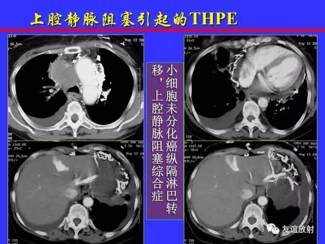 肝实质异常灌注CT、MRI评价