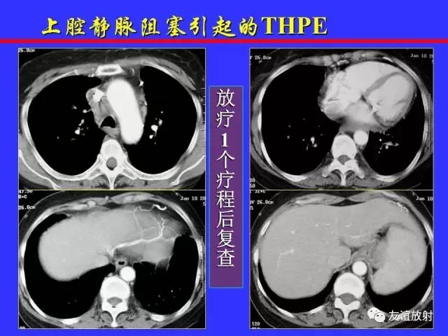 肝实质异常灌注CT、MRI评价