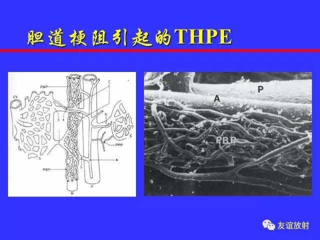 肝实质异常灌注CT、MRI评价