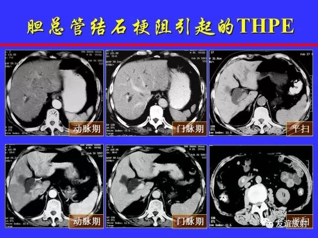 肝实质异常灌注CT、MRI评价
