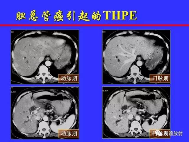 肝实质异常灌注CT、MRI评价