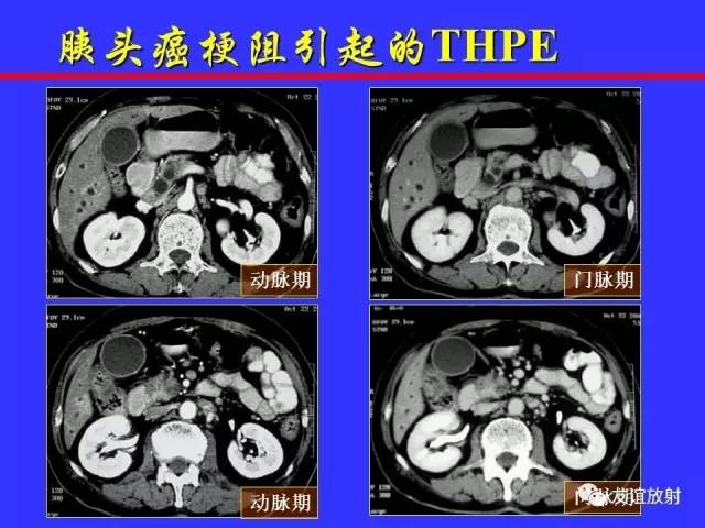 肝实质异常灌注CT、MRI评价