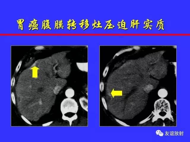 肝实质异常灌注CT、MRI评价