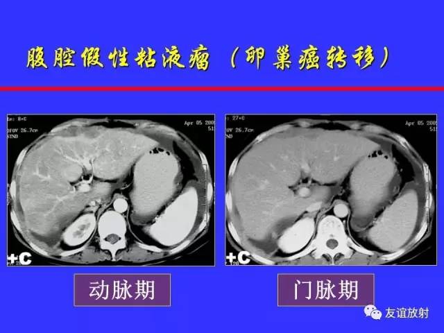 肝实质异常灌注CT、MRI评价
