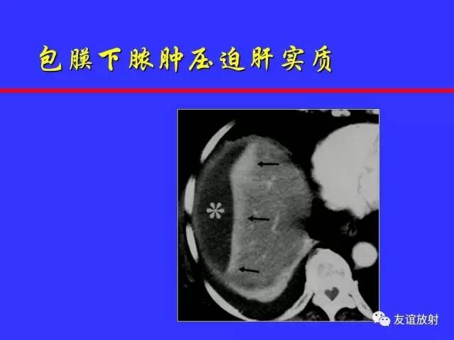 肝实质异常灌注CT、MRI评价
