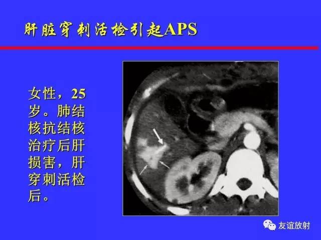 肝实质异常灌注CT、MRI评价