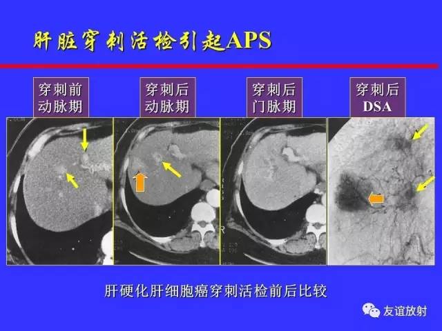 肝实质异常灌注CT、MRI评价
