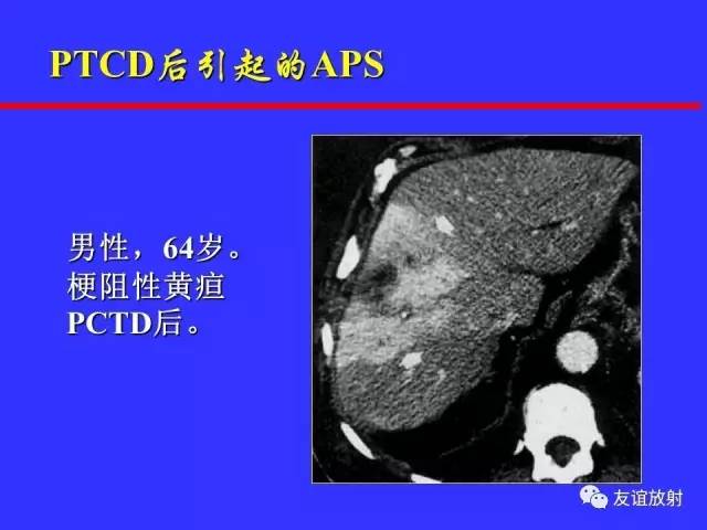 肝实质异常灌注CT、MRI评价