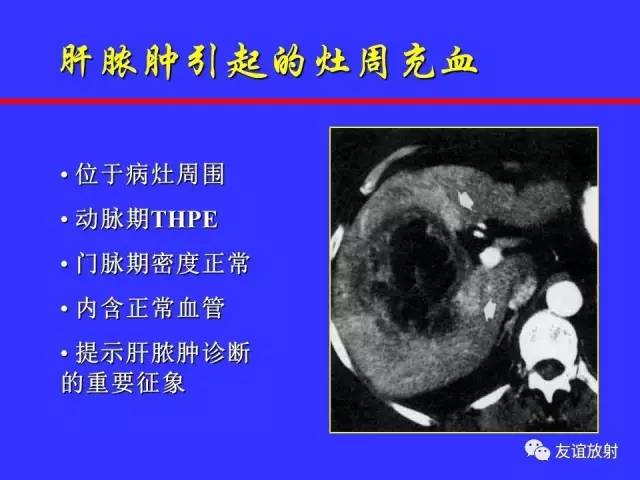 肝实质异常灌注CT、MRI评价