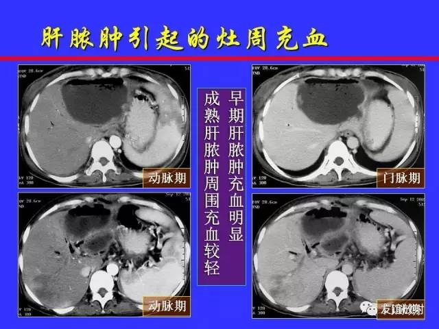 肝实质异常灌注CT、MRI评价
