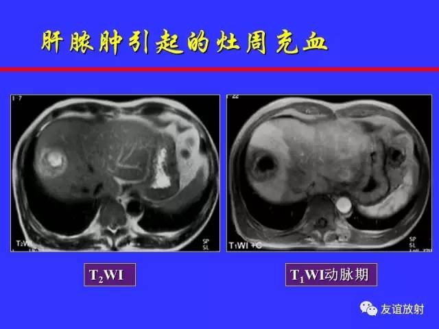 肝实质异常灌注CT、MRI评价