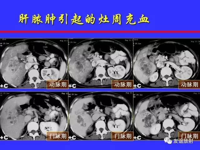 肝实质异常灌注CT、MRI评价