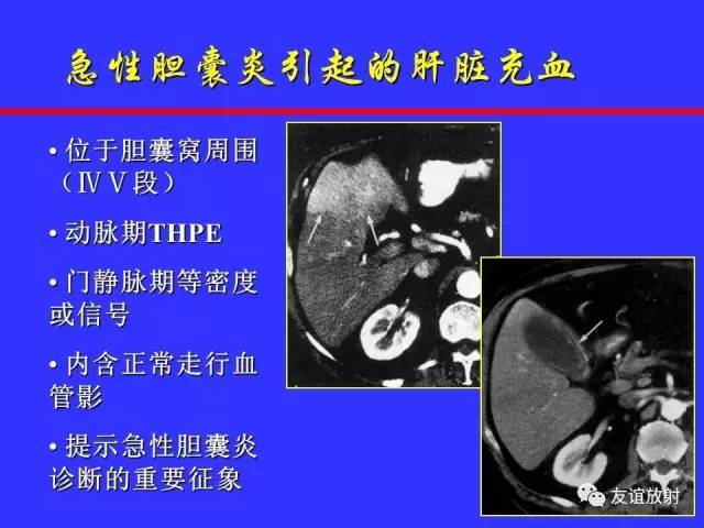肝实质异常灌注CT、MRI评价