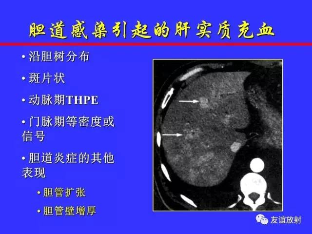 肝实质异常灌注CT、MRI评价