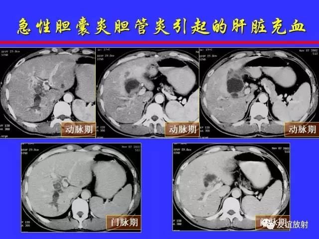 肝实质异常灌注CT、MRI评价