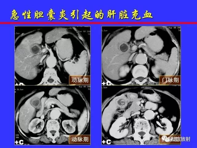 肝实质异常灌注CT、MRI评价