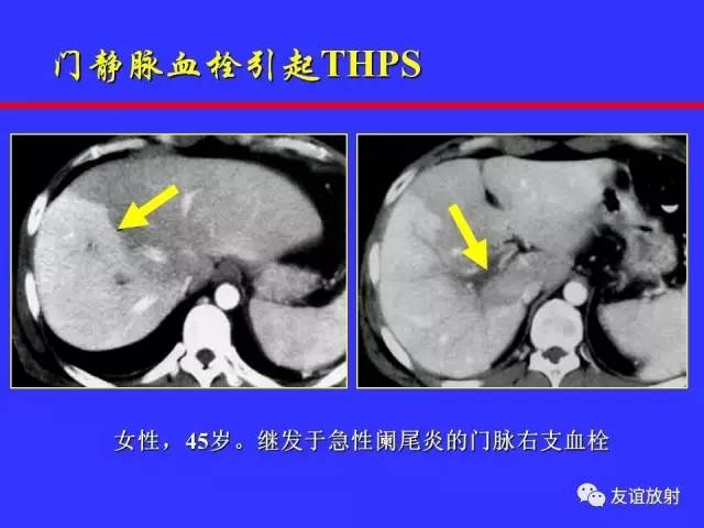 肝实质异常灌注CT、MRI评价