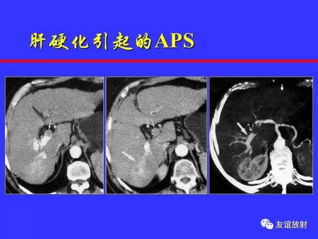 肝实质异常灌注CT、MRI评价