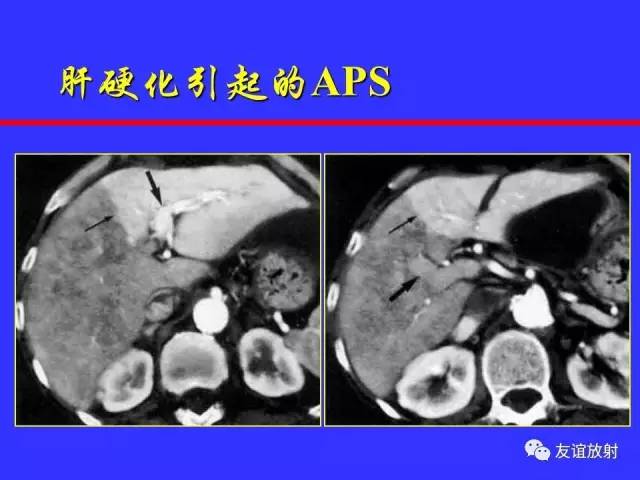 肝实质异常灌注CT、MRI评价