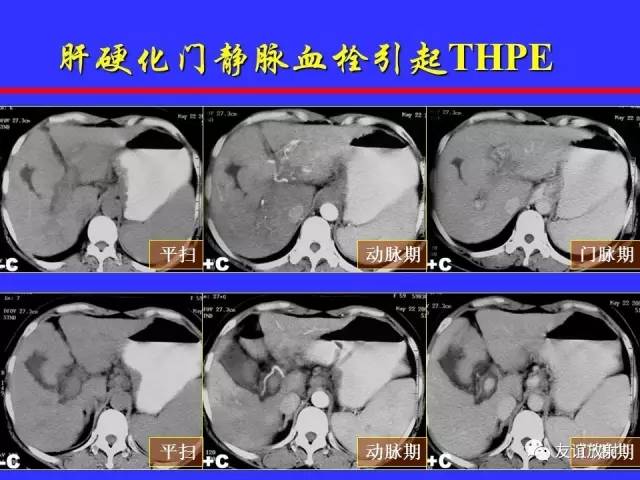 肝实质异常灌注CT、MRI评价