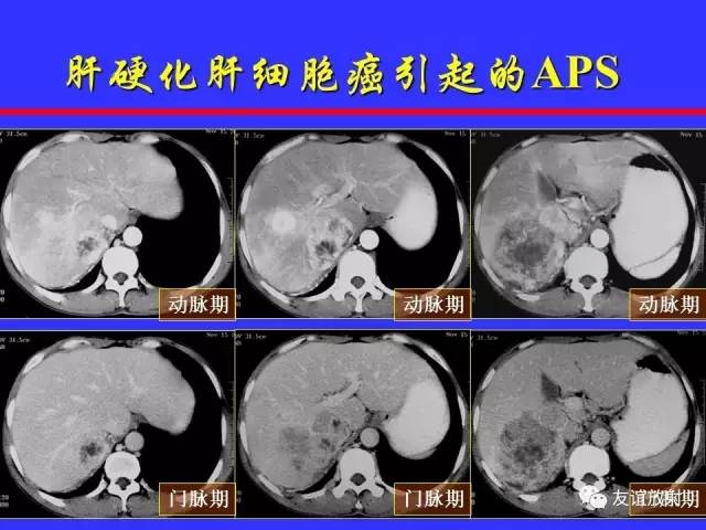 肝实质异常灌注CT、MRI评价