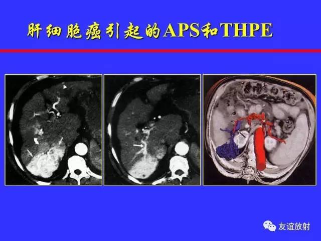肝实质异常灌注CT、MRI评价
