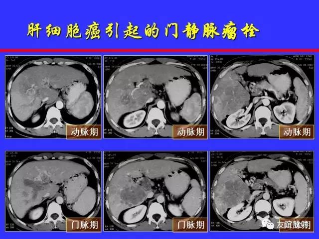 肝实质异常灌注CT、MRI评价