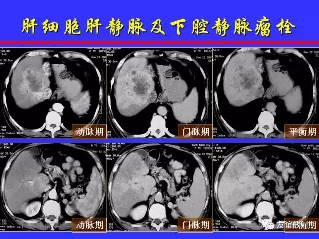 肝实质异常灌注CT、MRI评价