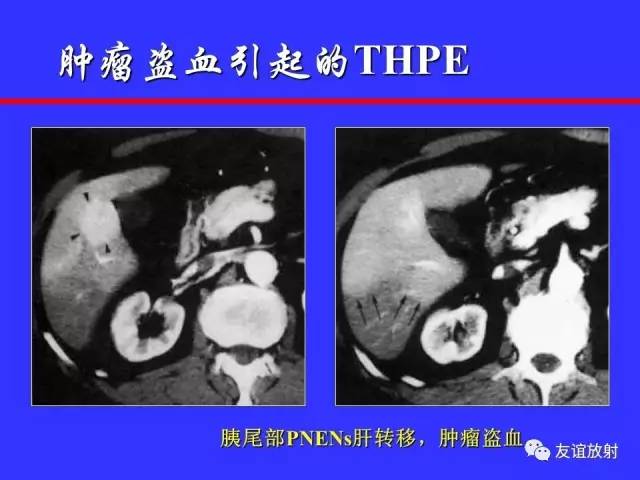 肝实质异常灌注CT、MRI评价