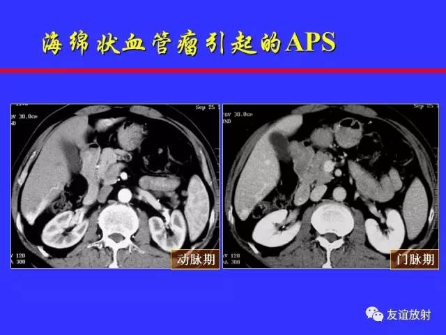 肝实质异常灌注CT、MRI评价