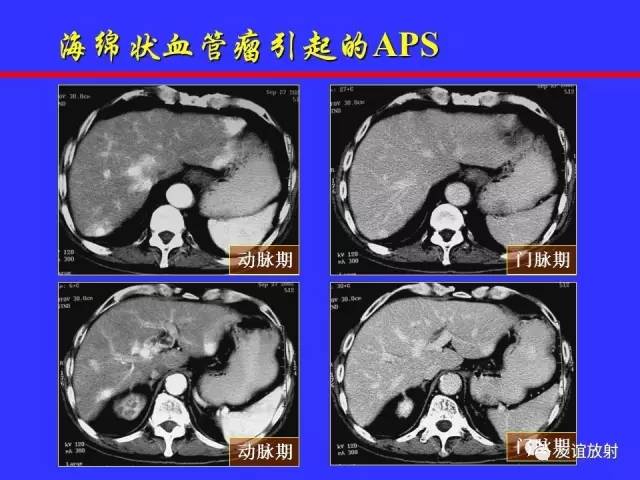 肝实质异常灌注CT、MRI评价
