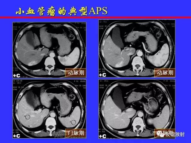 肝实质异常灌注CT、MRI评价