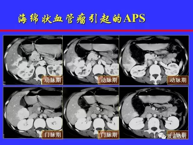 肝实质异常灌注CT、MRI评价