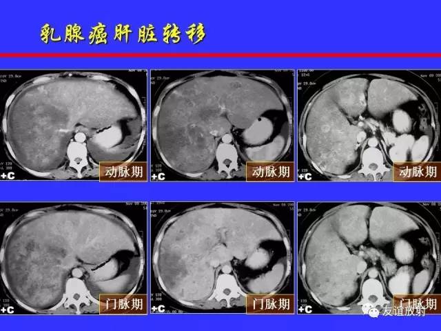 肝实质异常灌注CT、MRI评价