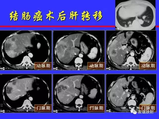 肝实质异常灌注CT、MRI评价