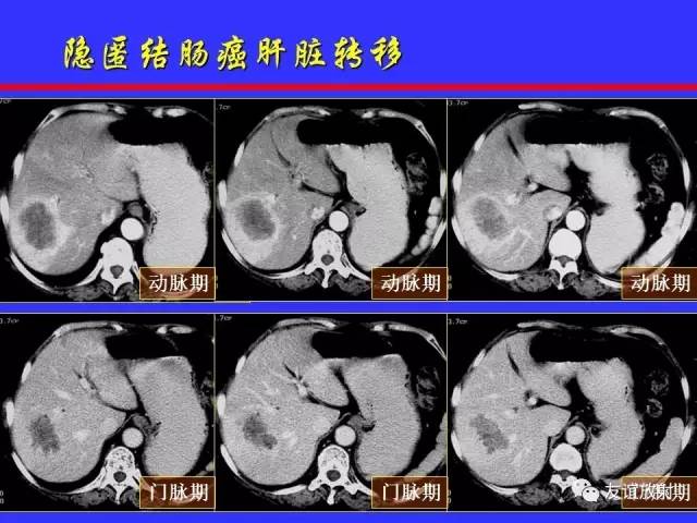 肝实质异常灌注CT、MRI评价