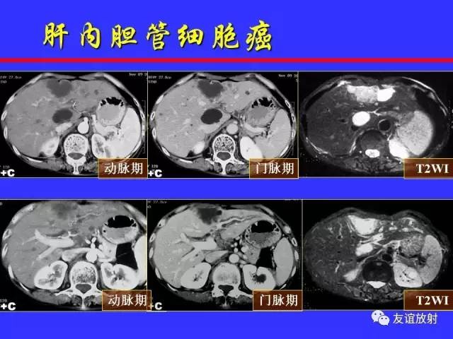 肝实质异常灌注CT、MRI评价