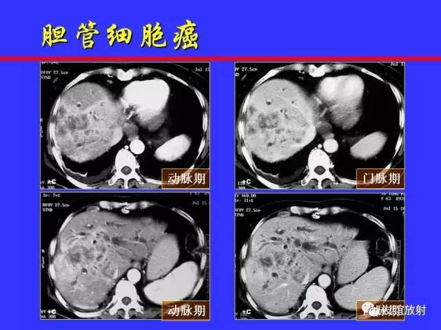 肝实质异常灌注CT、MRI评价