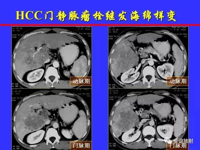 肝实质异常灌注CT、MRI评价